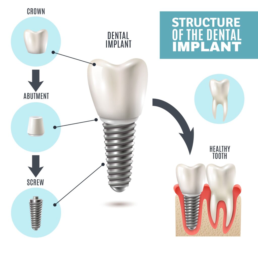 dental implant