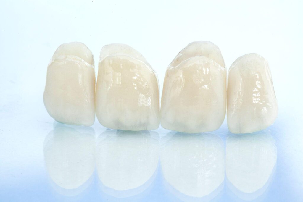 Best zirconia crowns in Kondapur