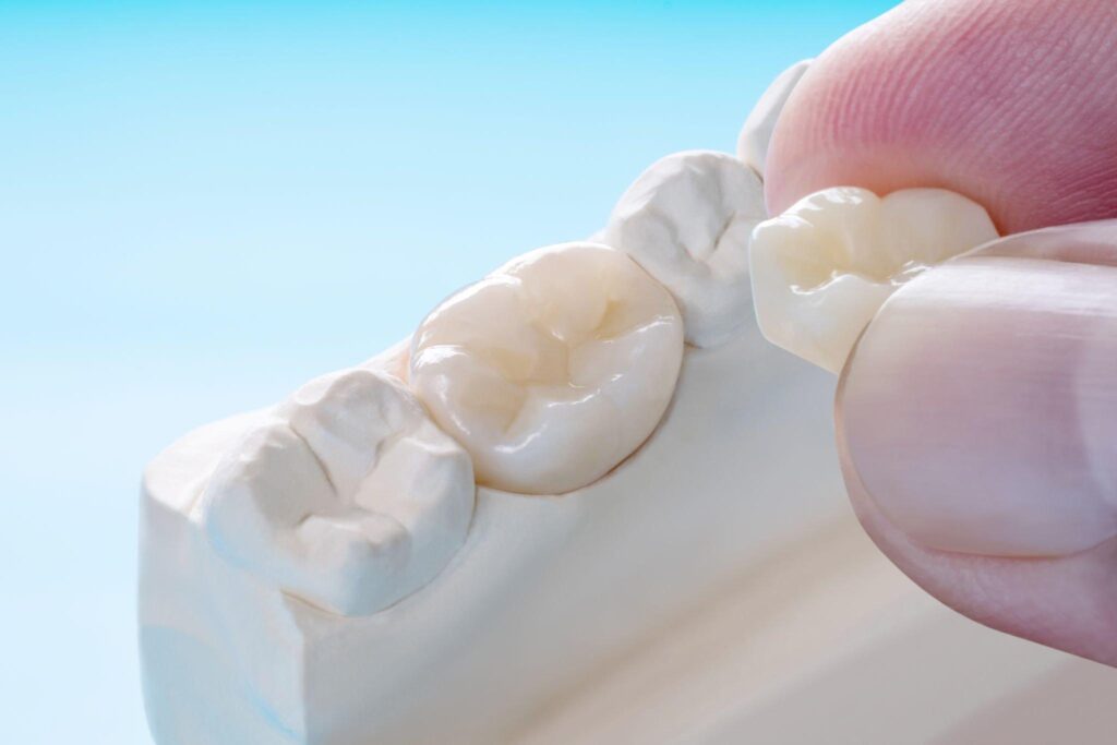 Best zirconia crowns in kondapur, Hyderabad