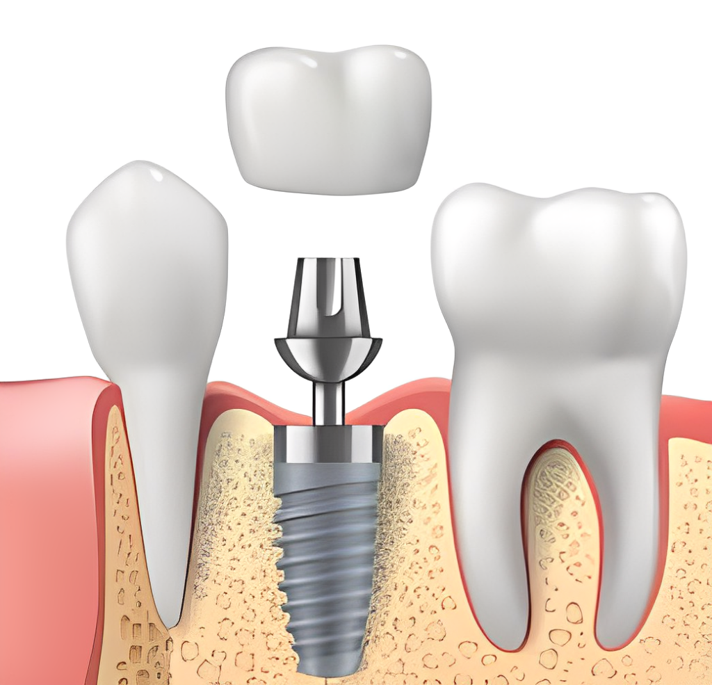 Dental implants in Kondapur