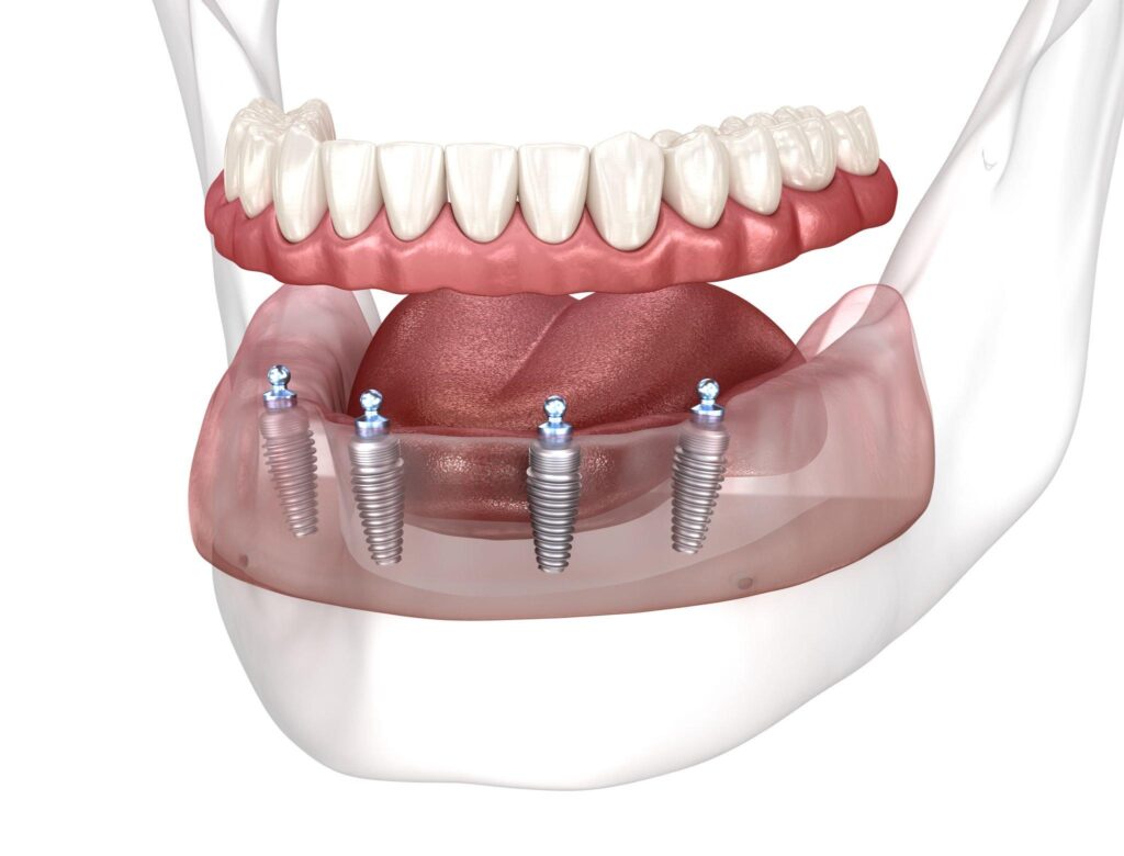 Full mouth Rehabilitation in Kondapur