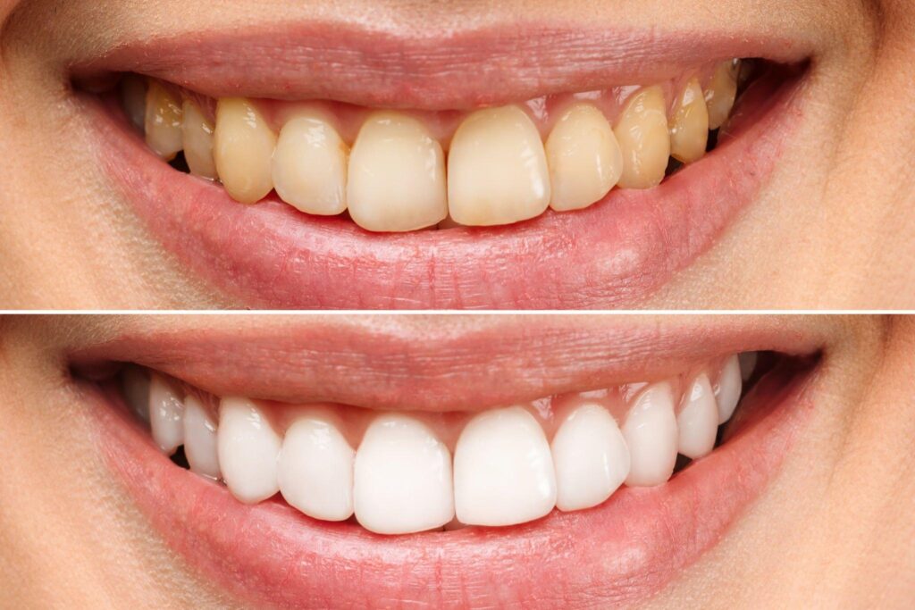 BEST DENTAL HOSPITAL FOR TEETH WHITENING